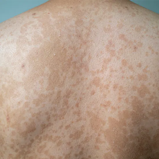 Tinea Corporis